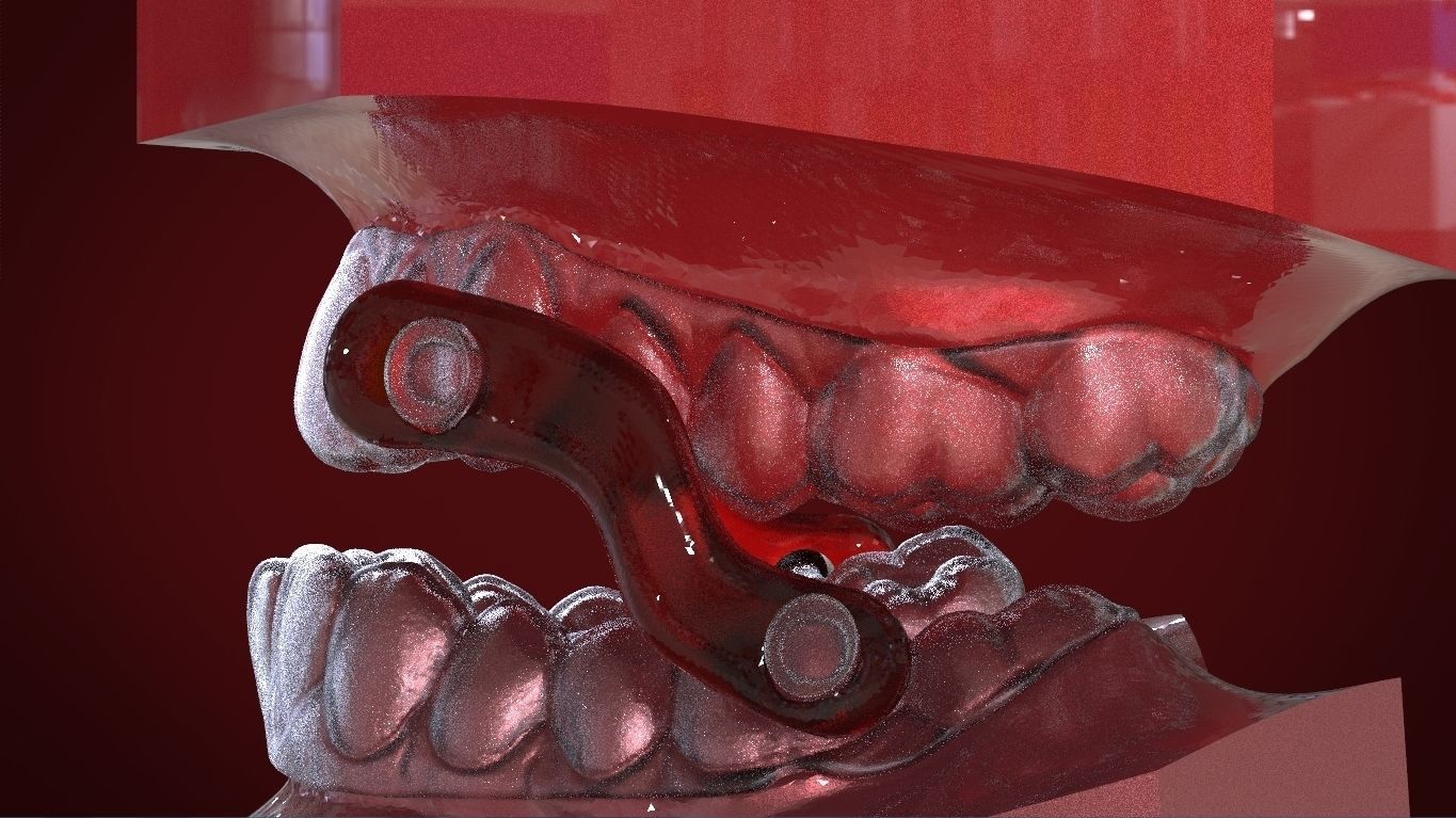 Digital Sleep Apnea Mouthguard 3D print model_16