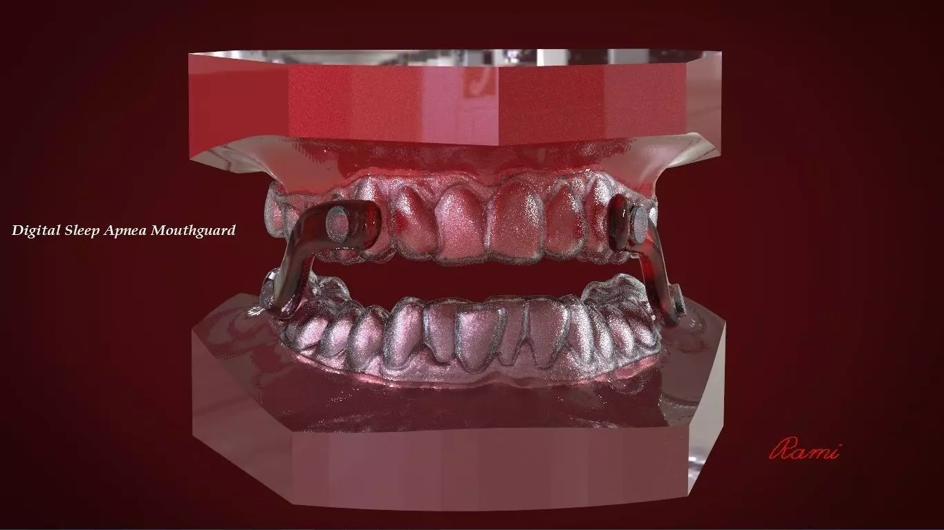 Digital Sleep Apnea Mouthguard 3D print model_0