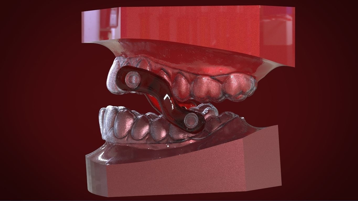 Digital Sleep Apnea Mouthguard 3D print model_9