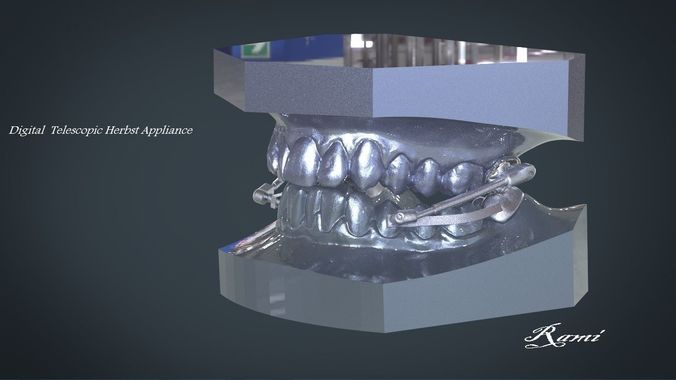 Digital Telescopic Herbst Appliance 3D print model