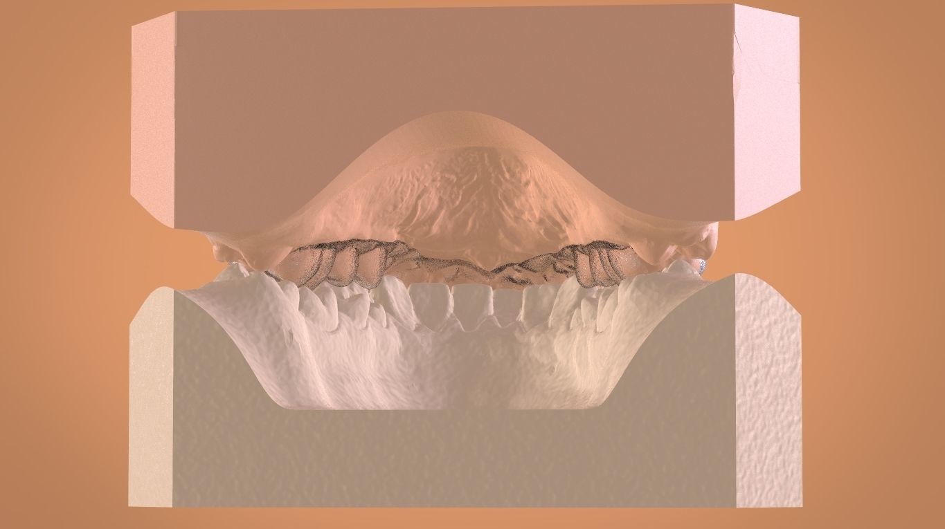 Digital Bleaching Tray 3D print model_12