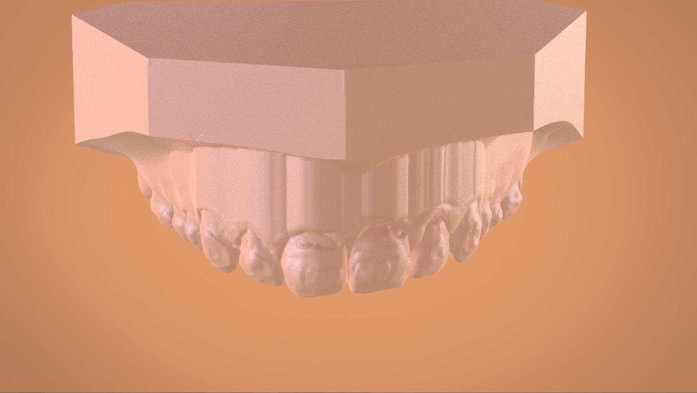 Digital Bleaching Tray 3D print model_16