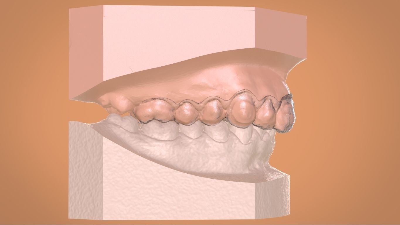 Digital Bleaching Tray 3D print model_9