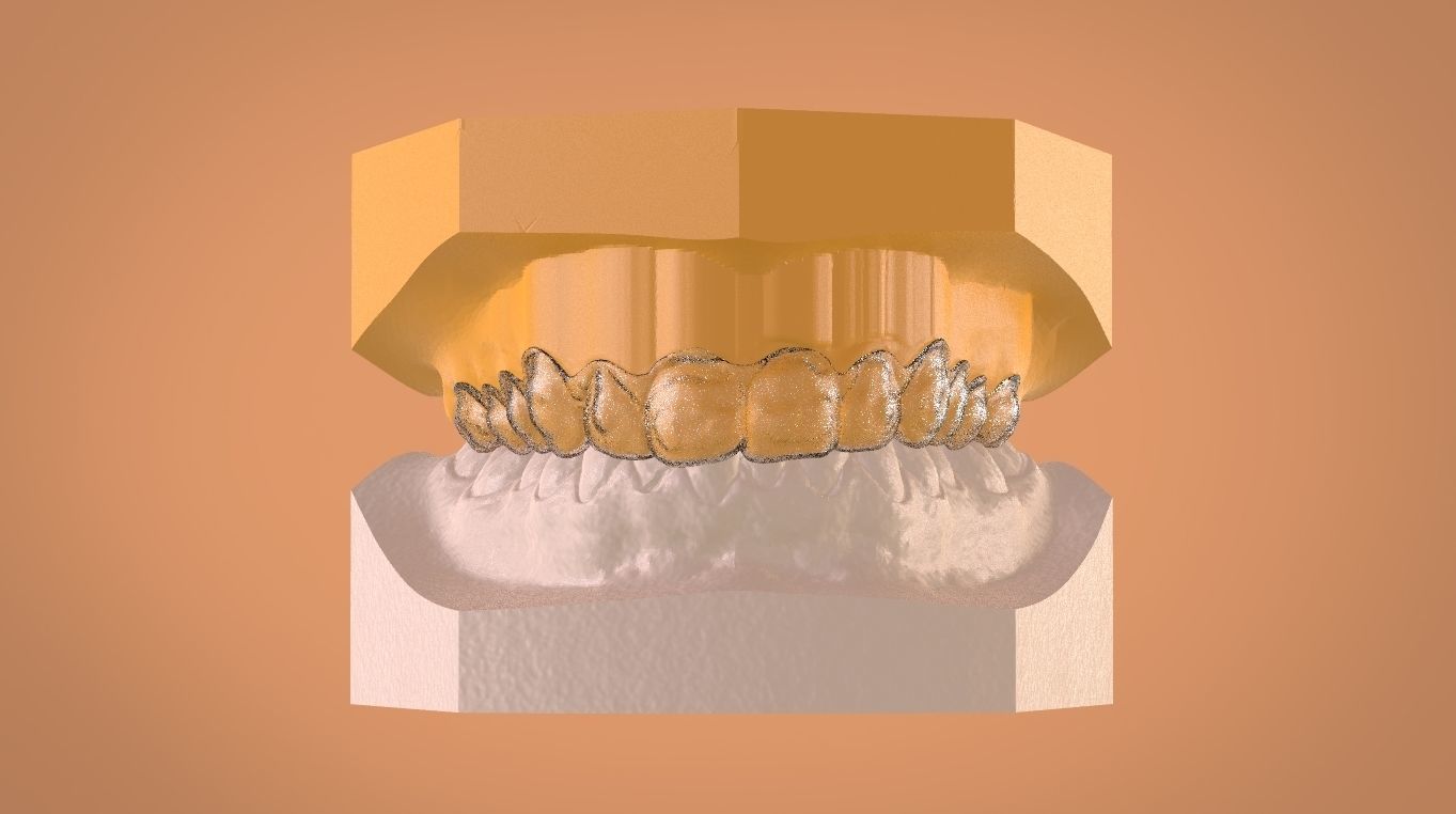 Digital Bleaching Tray 3D print model_1