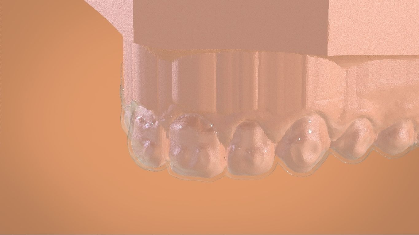 Digital Bleaching Tray 3D print model_22