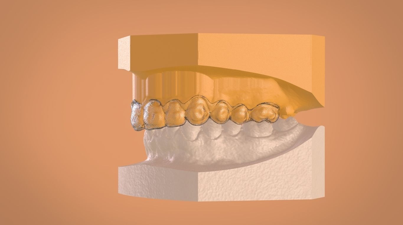 Digital Bleaching Tray 3D print model_10