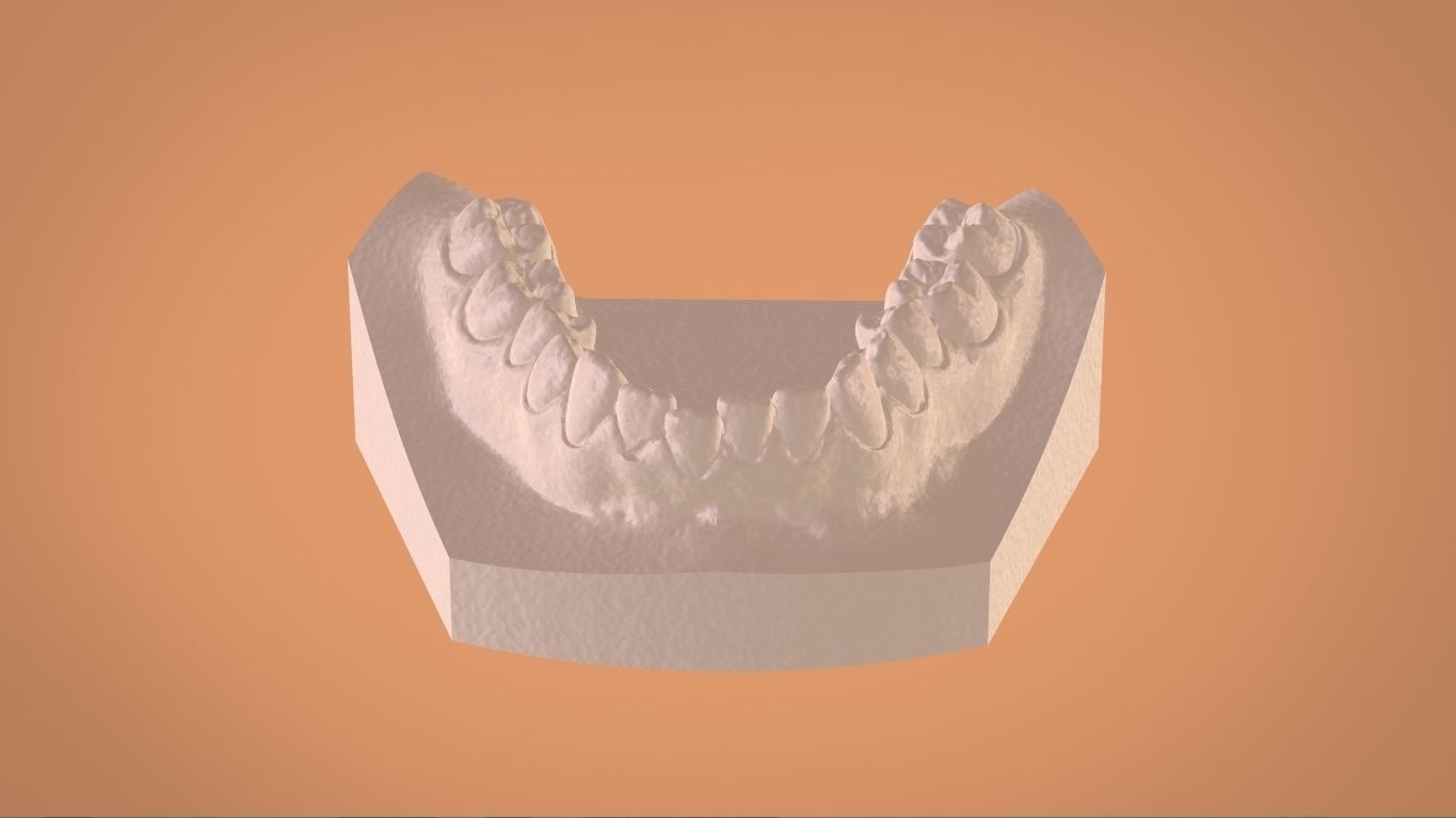 Digital Bleaching Tray 3D print model_3