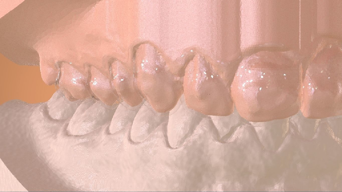 Digital Bleaching Tray 3D print model_20