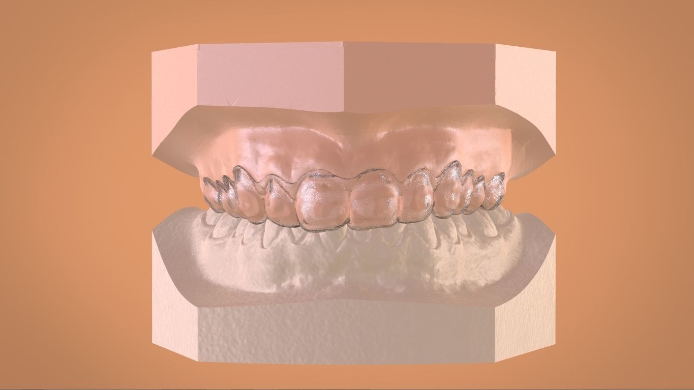 Digital Bleaching Tray 3D print model_8