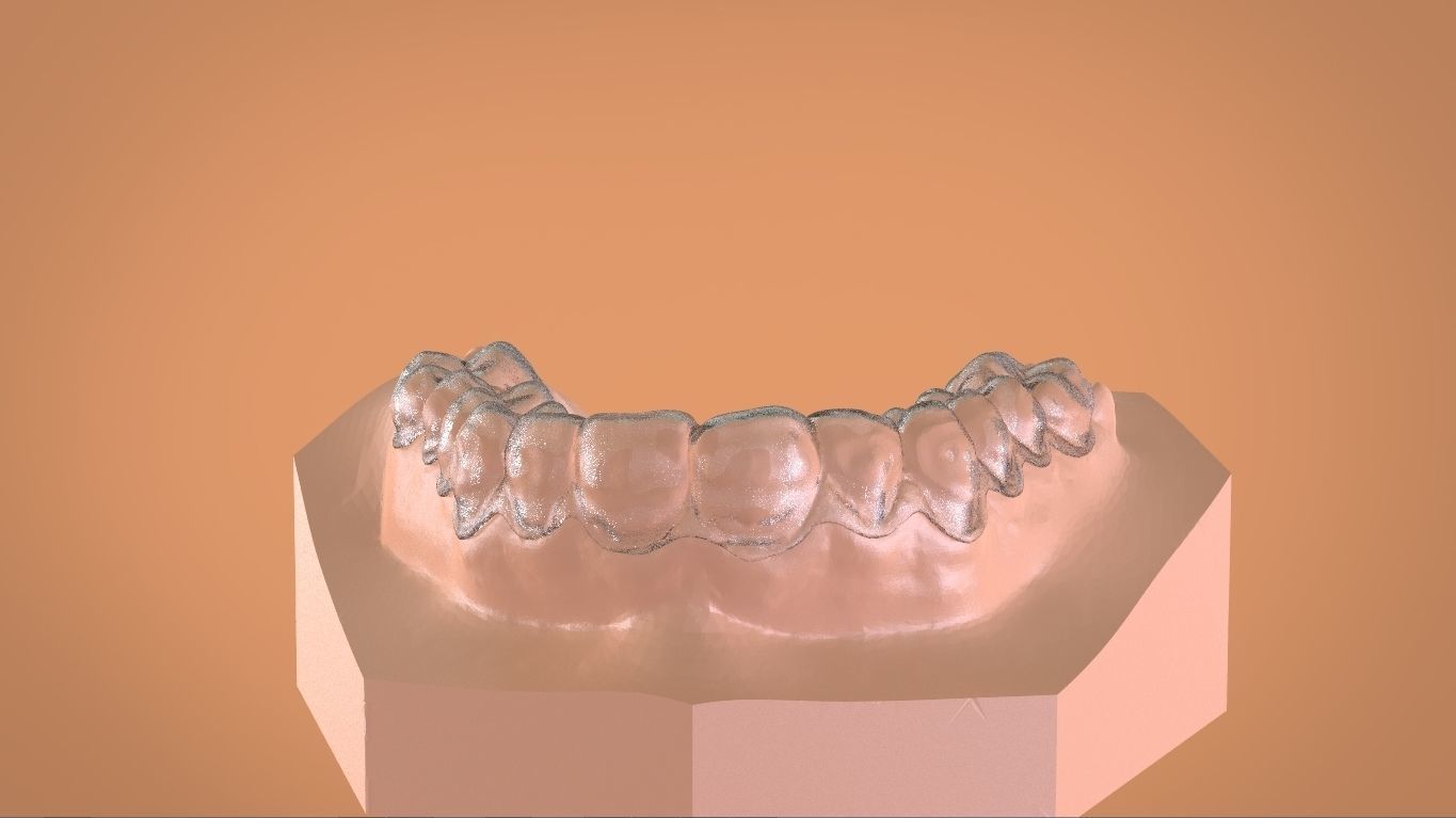 Digital Bleaching Tray 3D print model_13