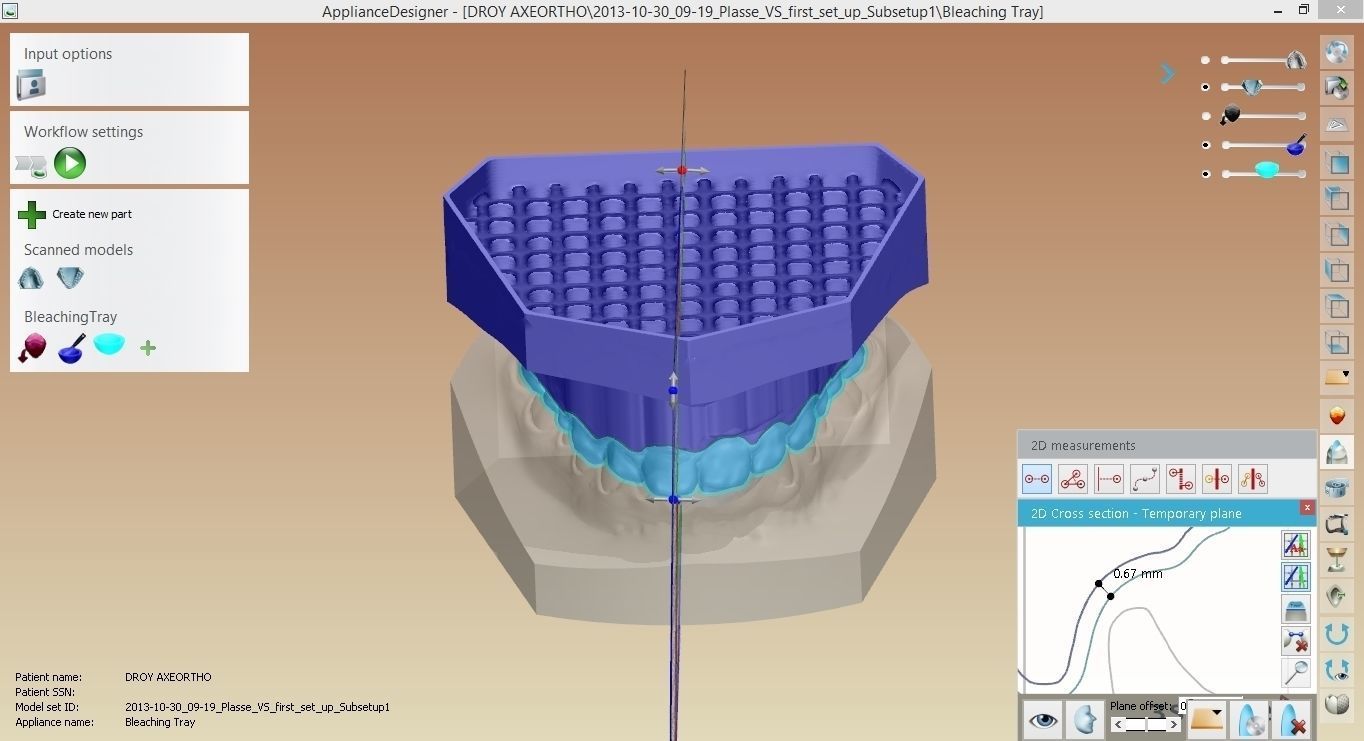 Digital Bleaching Tray 3D print model_4