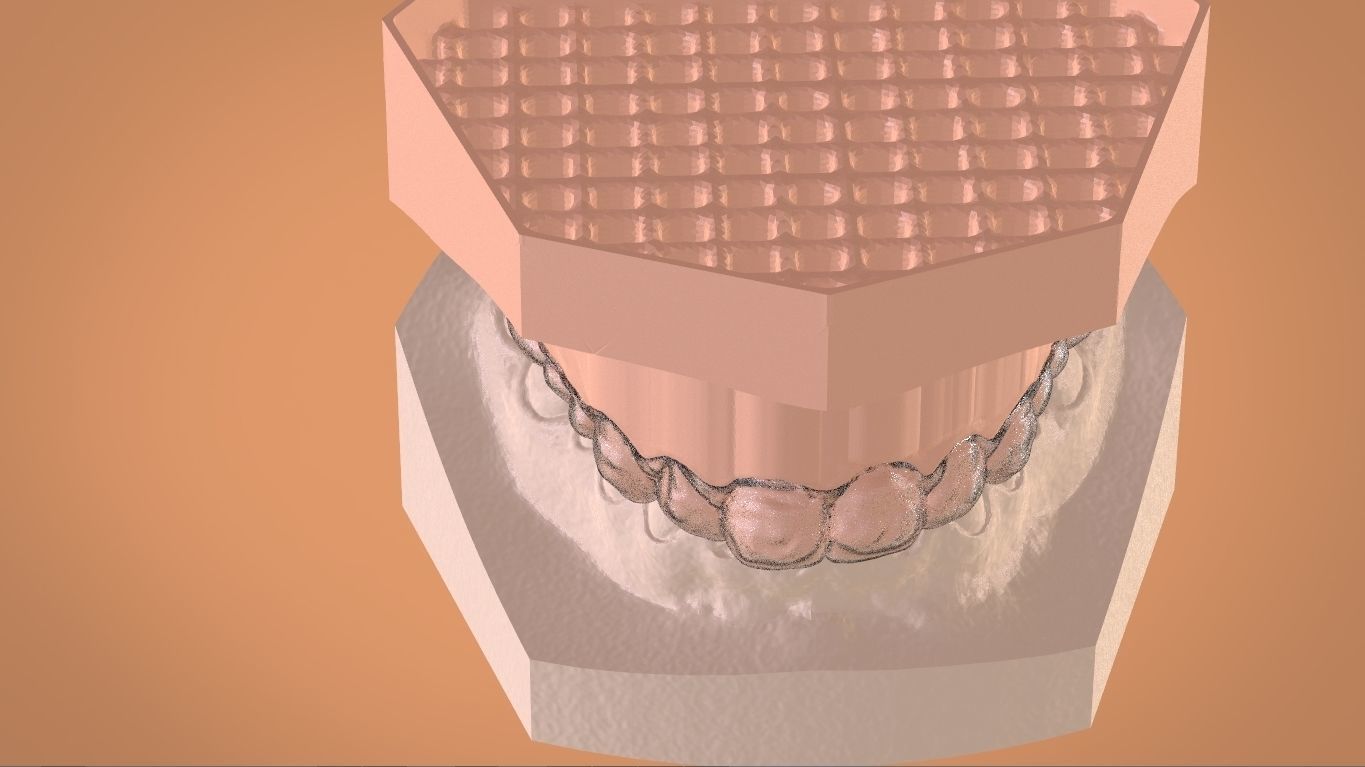 Digital Bleaching Tray 3D print model_19