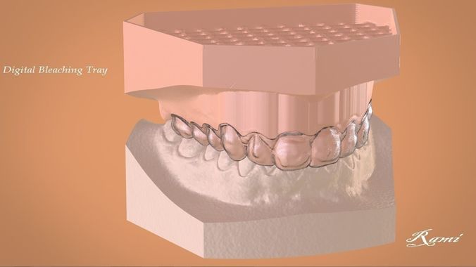 Digital Bleaching Tray 3D print model