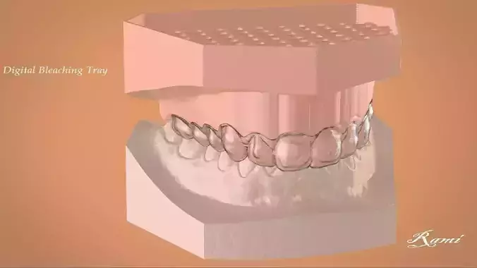 Digital Bleaching Tray 3D print model