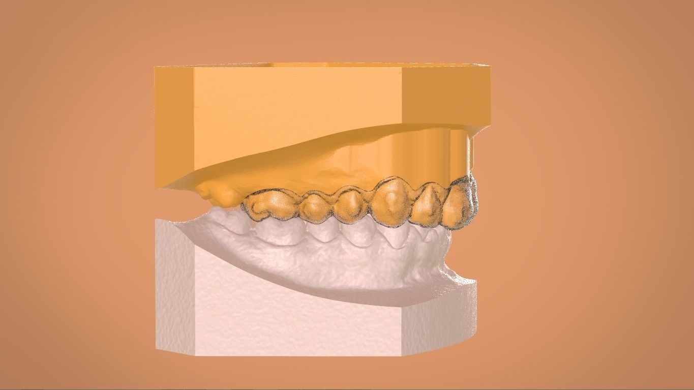 Digital Bleaching Tray 3D print model_5