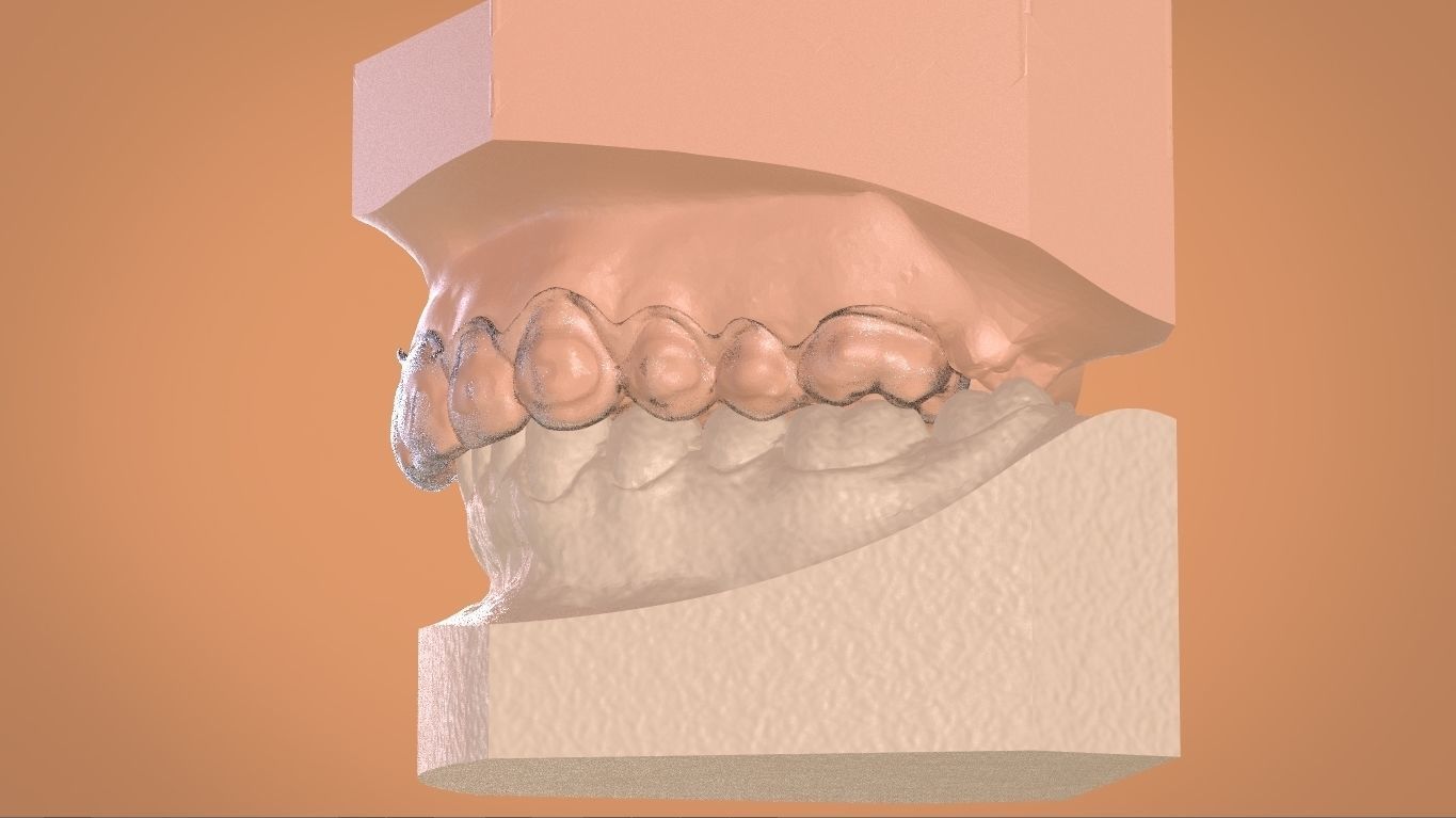 Digital Bleaching Tray 3D print model_11