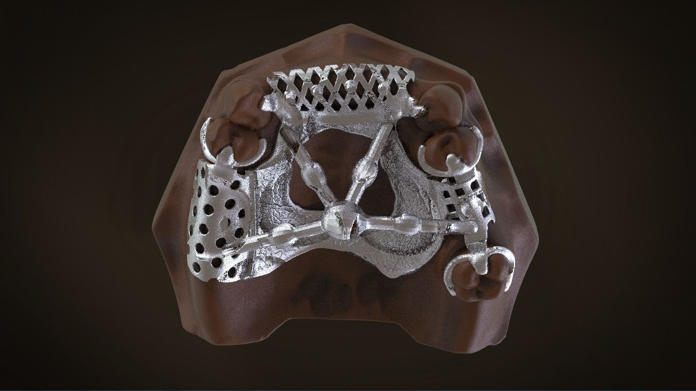 Digital Removable Partial Denture Framework 3D print model_12