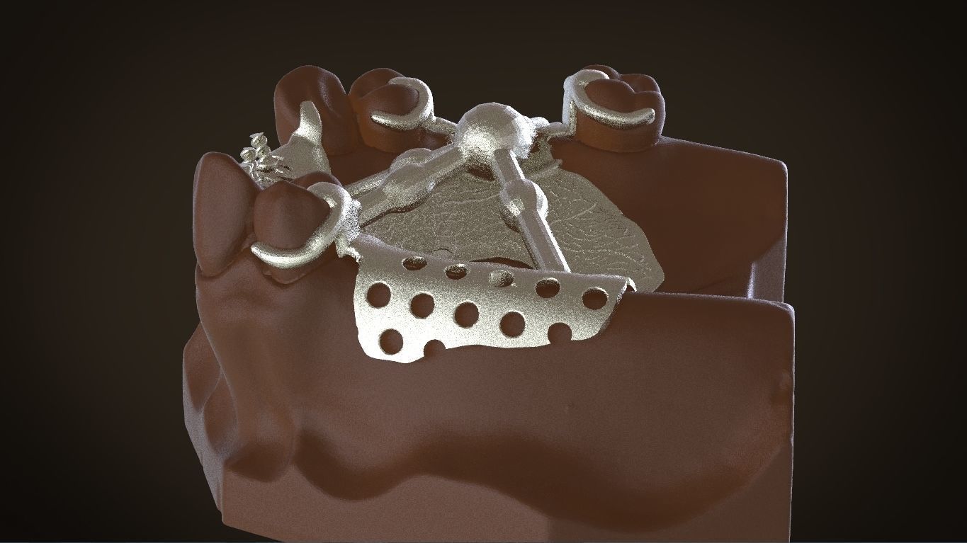 Digital Removable Partial Denture Framework 3D print model_15