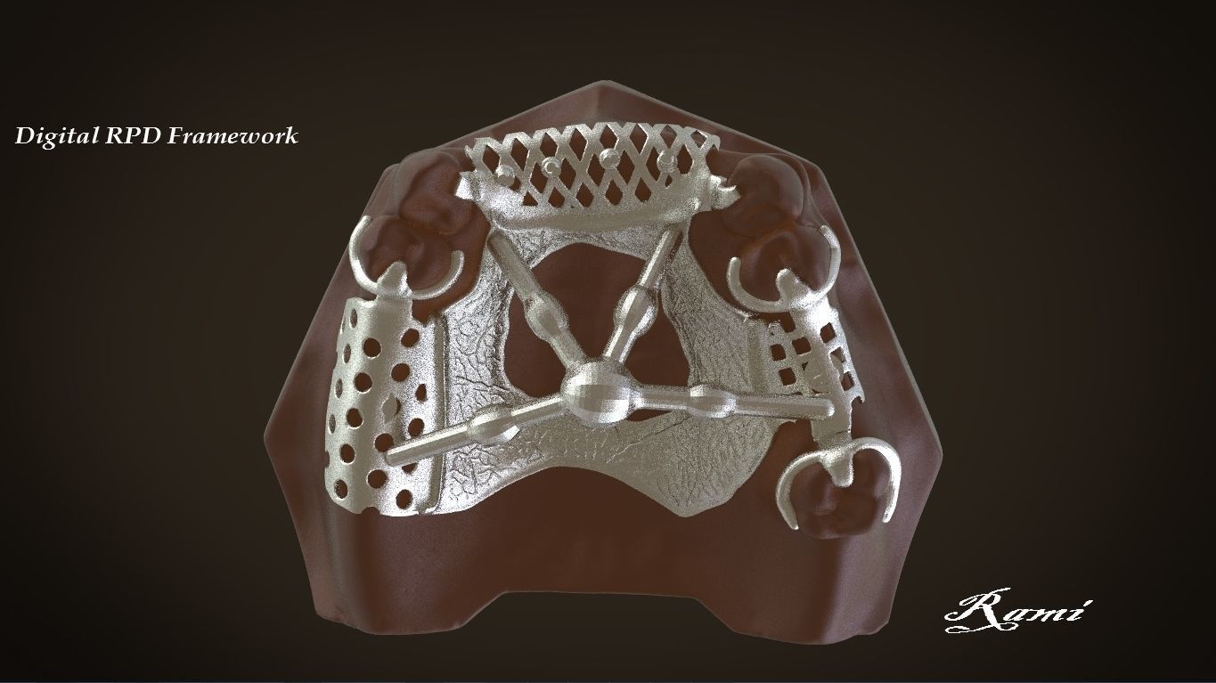Digital Removable Partial Denture Framework 3D print model_6
