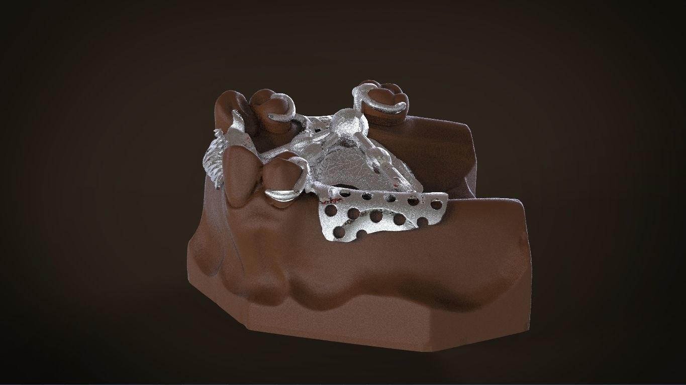 Digital Removable Partial Denture Framework 3D print model_13