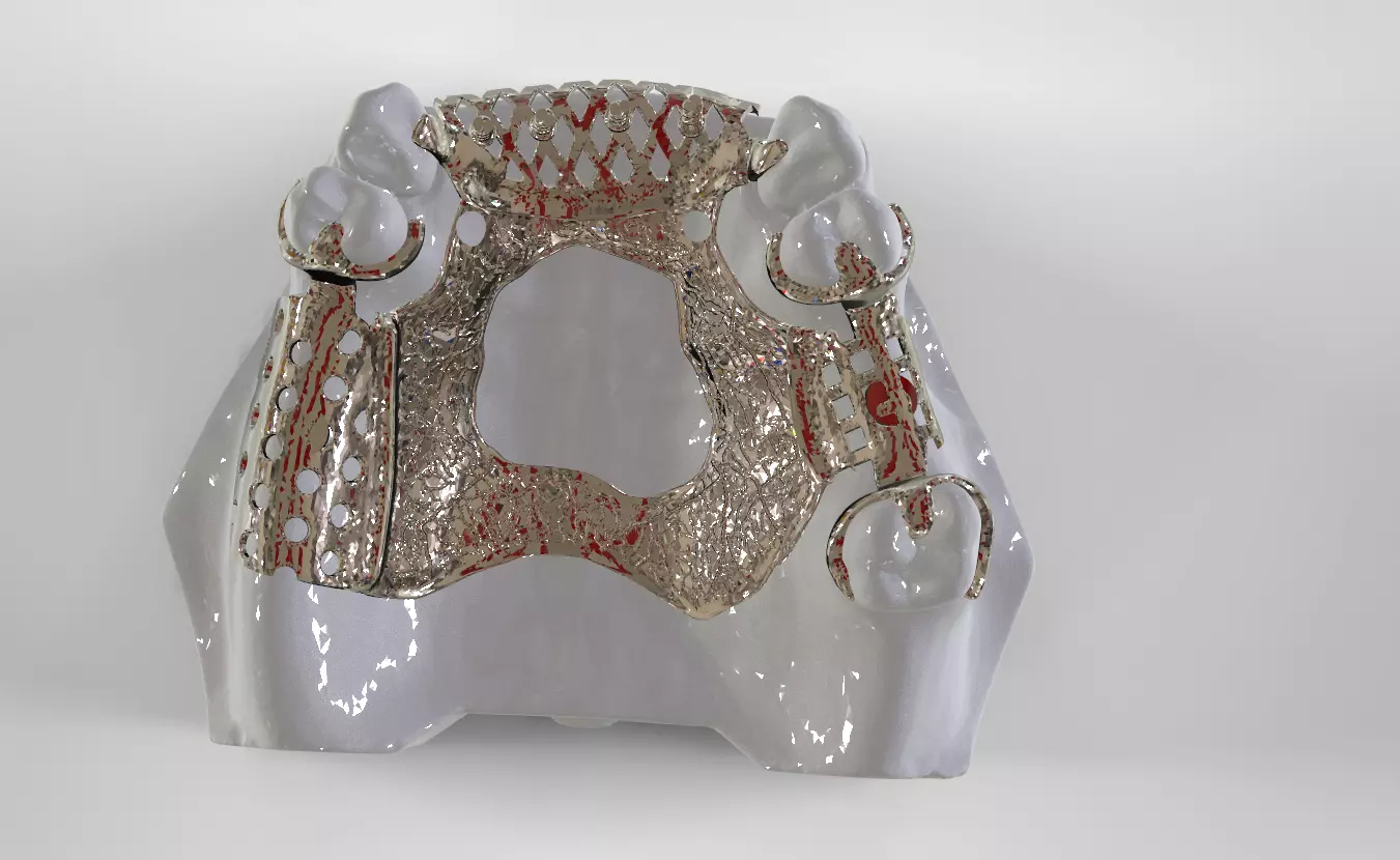 Digital Removable Partial Denture Framework 3D print model_0
