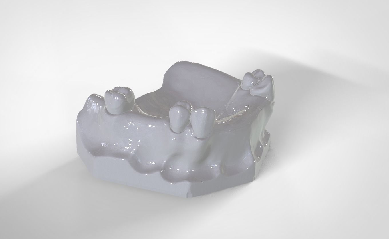 Digital Removable Partial Denture Framework 3D print model_5