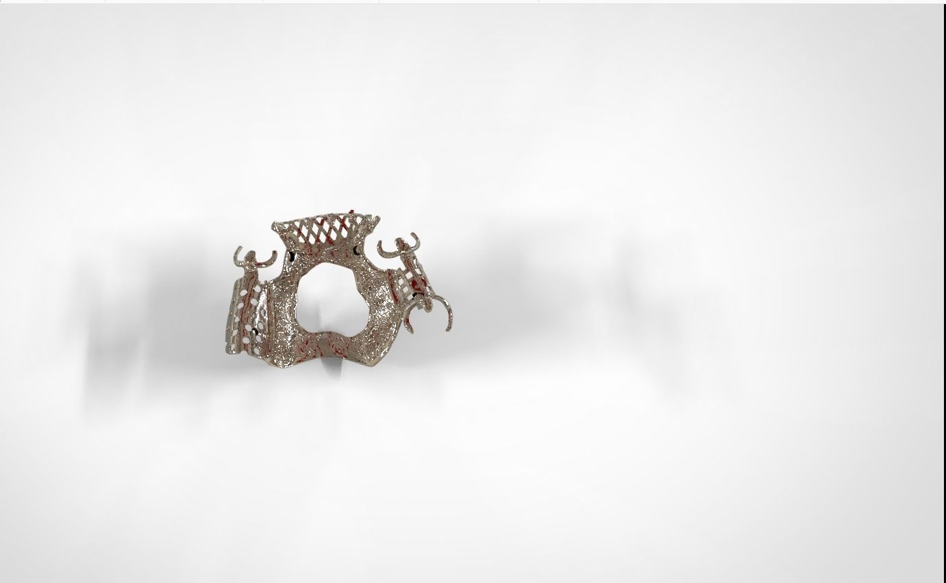 Digital Removable Partial Denture Framework 3D print model_4