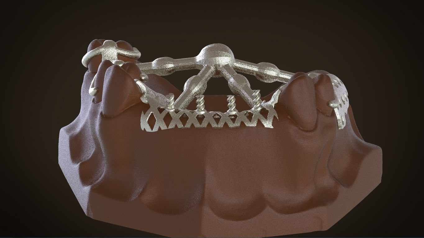 Digital Removable Partial Denture Framework 3D print model_18
