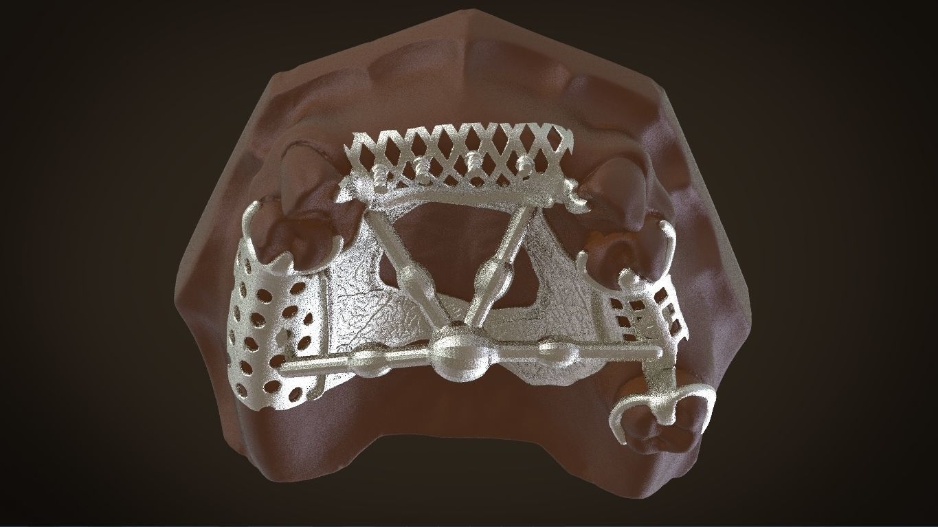 Digital Removable Partial Denture Framework 3D print model_17