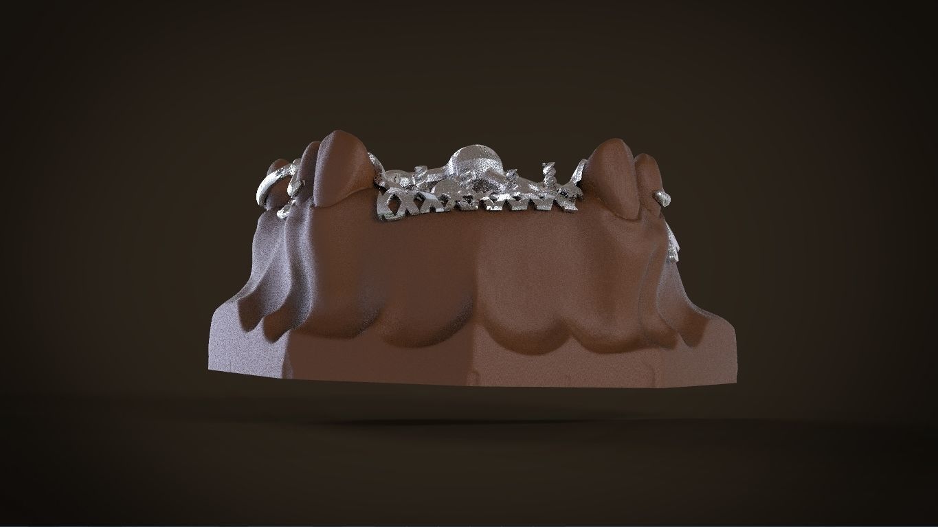 Digital Removable Partial Denture Framework 3D print model_11