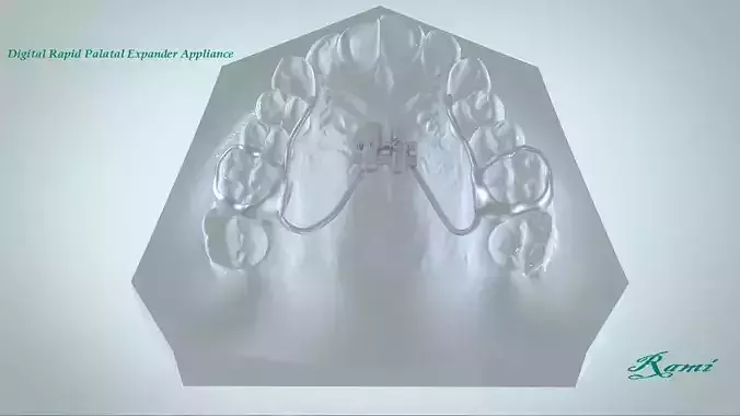 Digital Rapid Palatal Expander 3D print model