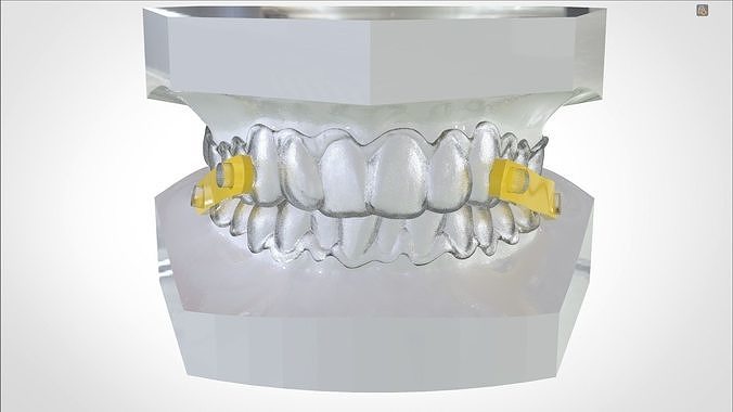 Digital Elastic Mandibular Advancement Device 3D print model