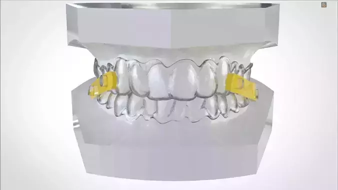 Digital Elastic Mandibular Advancement Device 3D print model