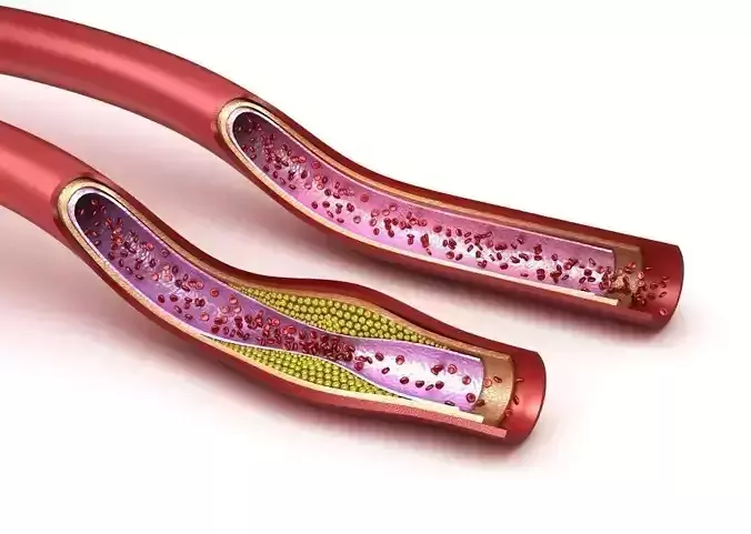 Blood vessel - normal and cholesterol damaged vessel
