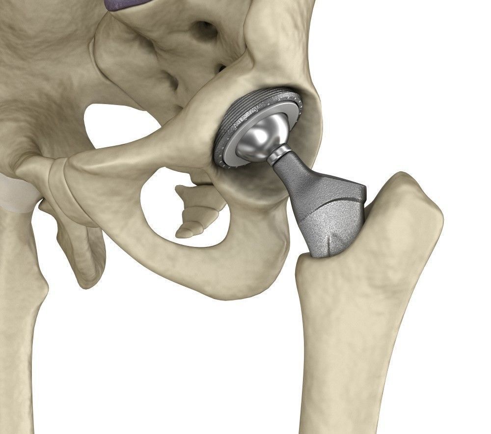 Hip replacement implant installed in the pelvis bone 3D model_7