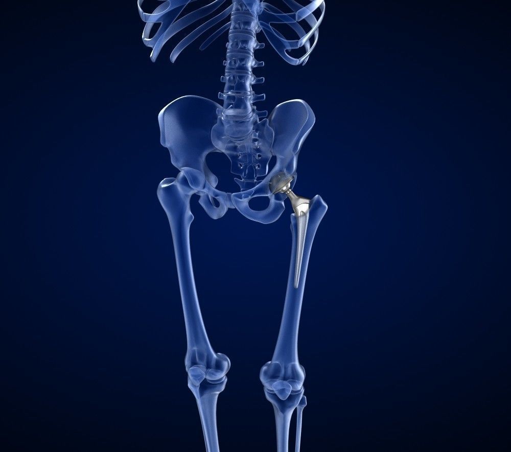 Hip replacement implant installed in the pelvis bone 3D model_16