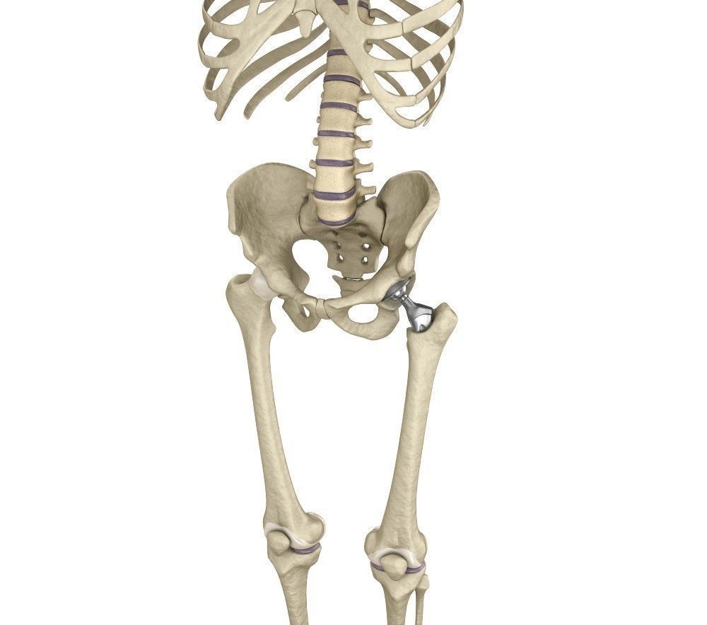 Hip replacement implant installed in the pelvis bone 3D model_5
