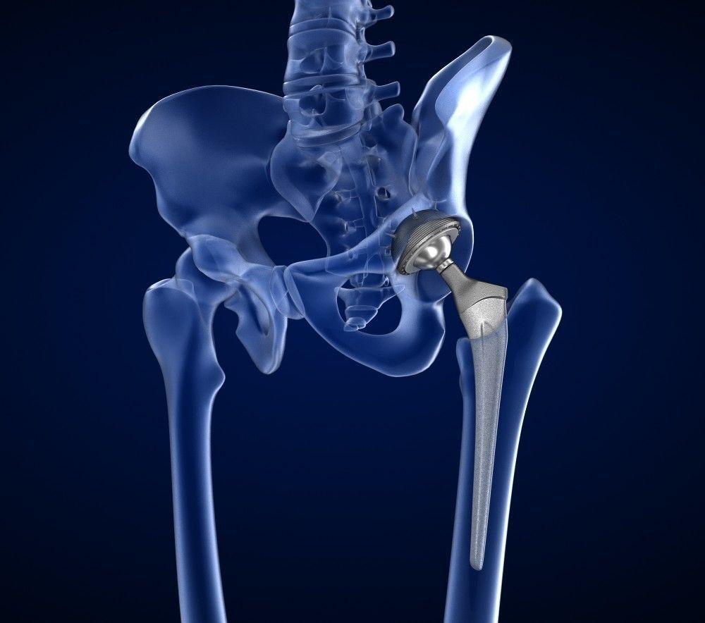 Hip replacement implant installed in the pelvis bone 3D model_2