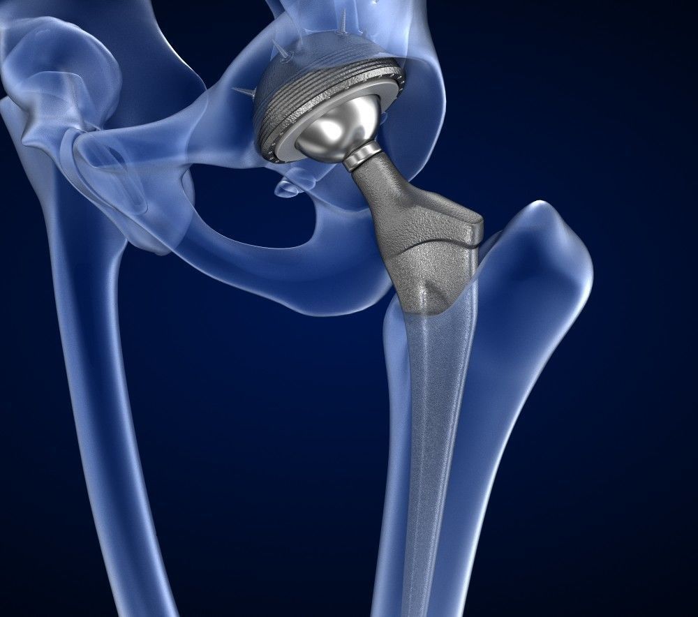 Hip replacement implant installed in the pelvis bone 3D model_14