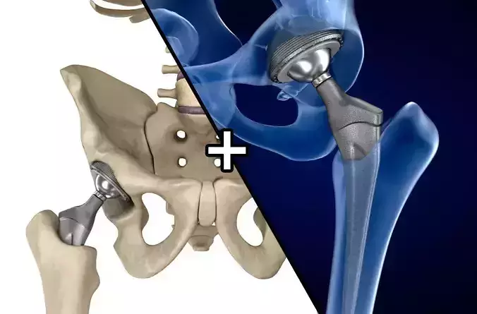 Hip replacement implant installed in the pelvis bone 3D model