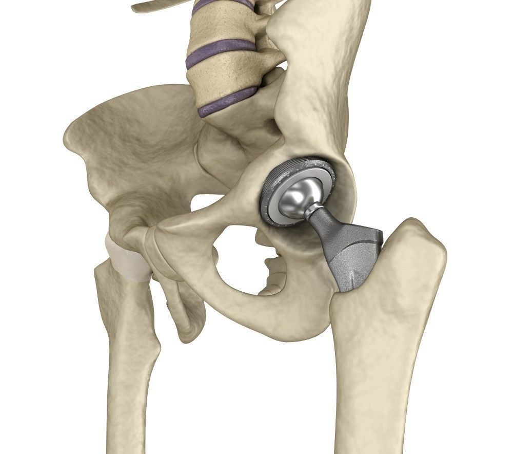 Hip replacement implant installed in the pelvis bone 3D model_6