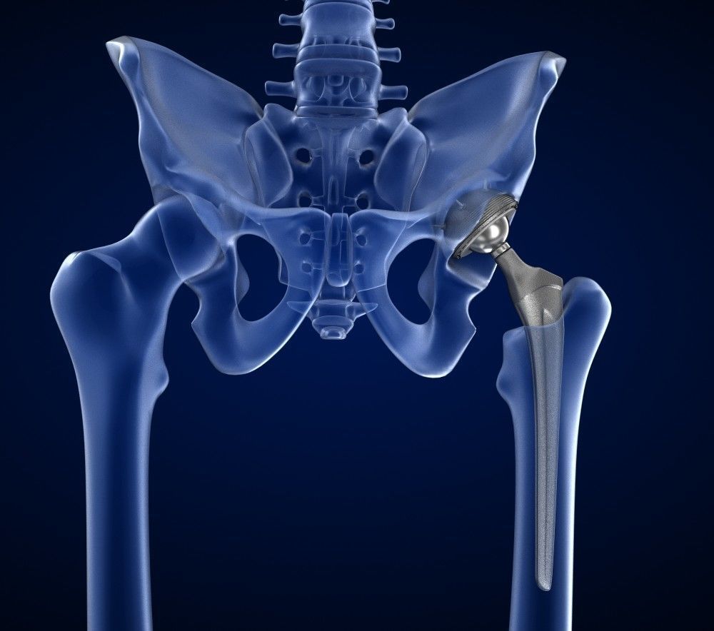 Hip replacement implant installed in the pelvis bone 3D model_15