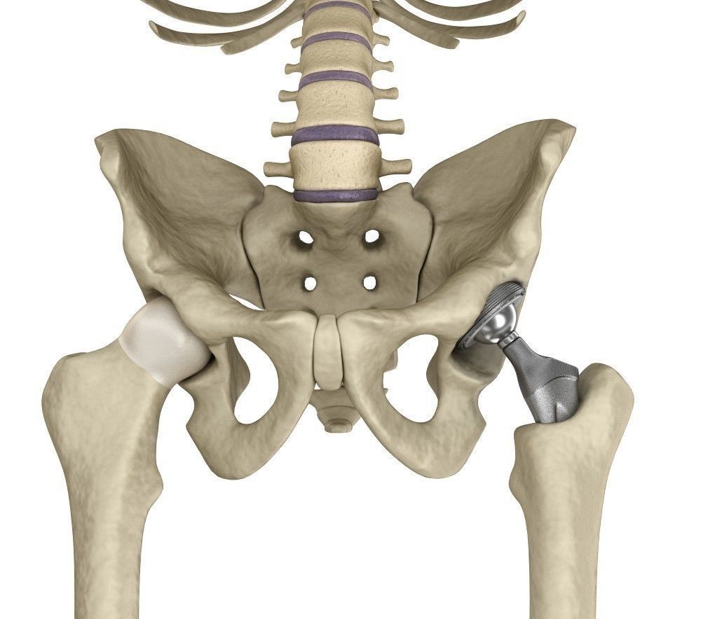Hip replacement implant installed in the pelvis bone 3D model_8