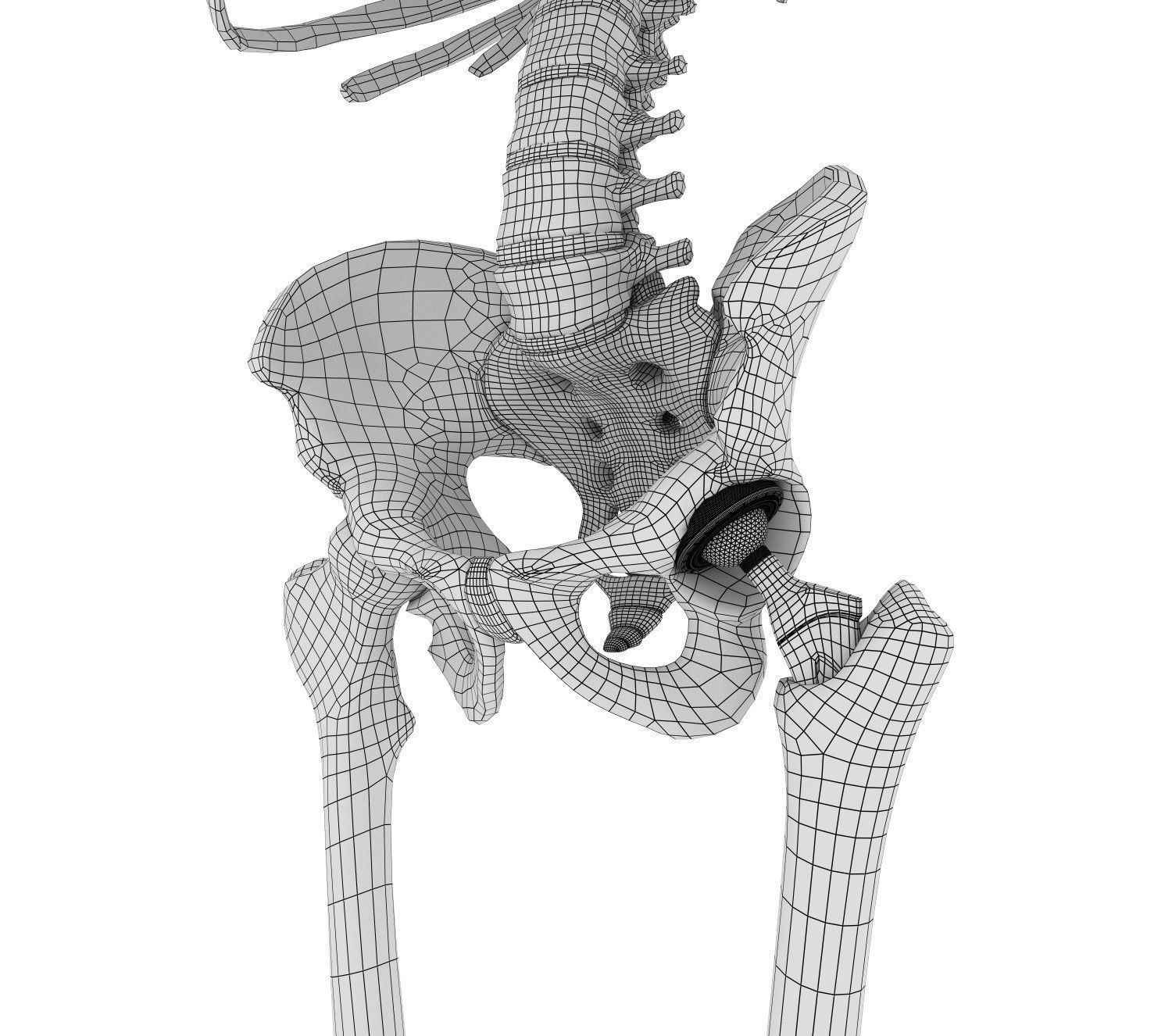 Hip replacement implant installed in the pelvis bone 3D model_3