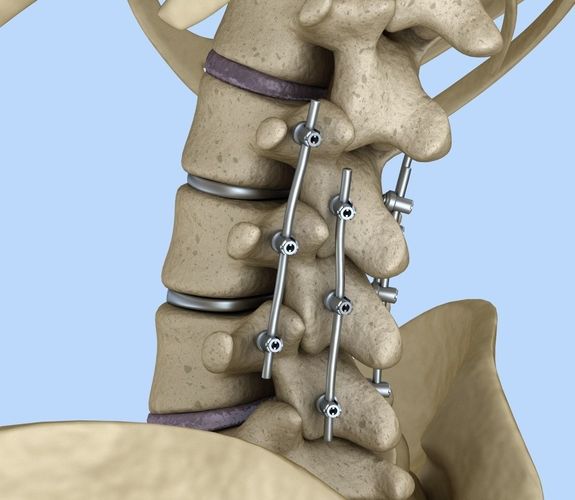 Spinal fixation system - titanium bracket 3D model