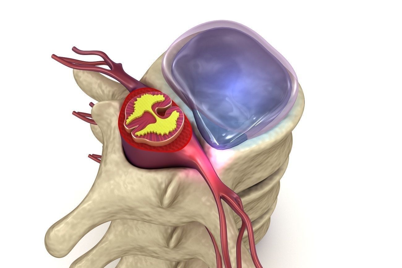 Hernaited  disc in human spine in details  3D model_1