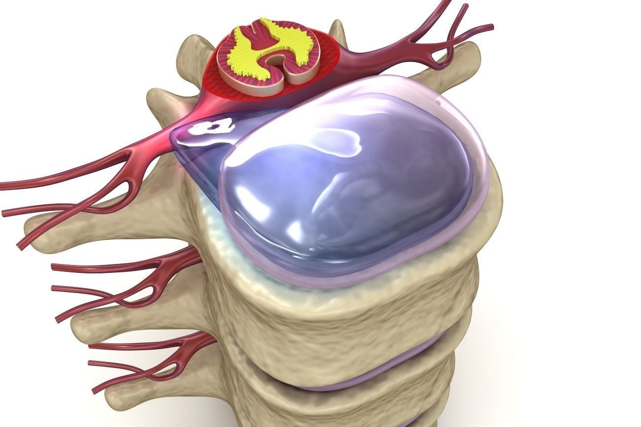 Hernaited  disc in human spine in details  3D model_10