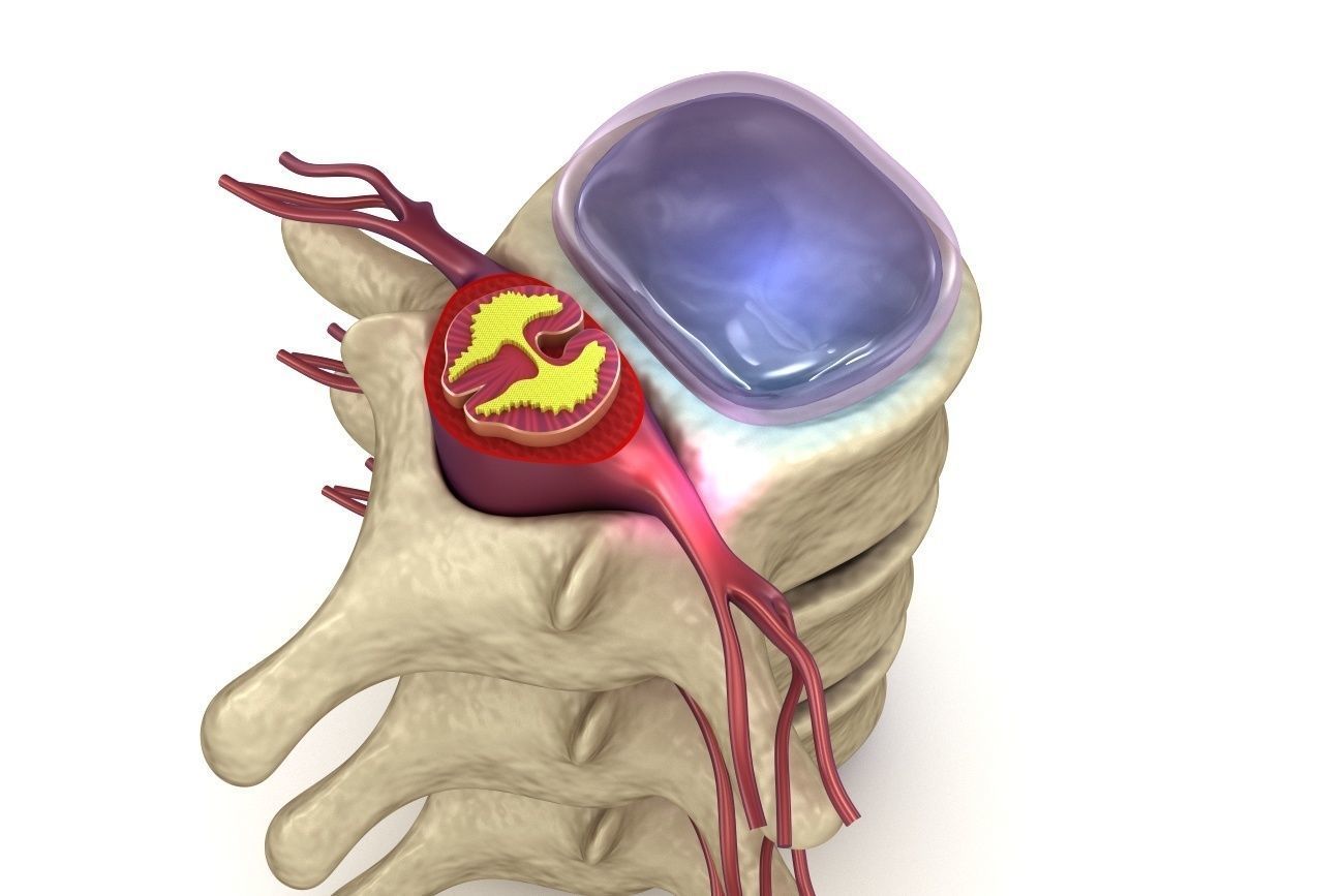 Hernaited  disc in human spine in details  3D model_2
