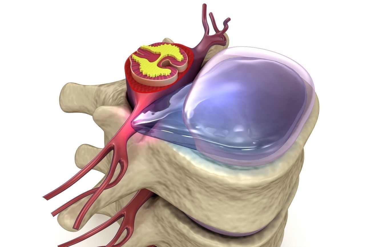 Hernaited  disc in human spine in details  3D model_8