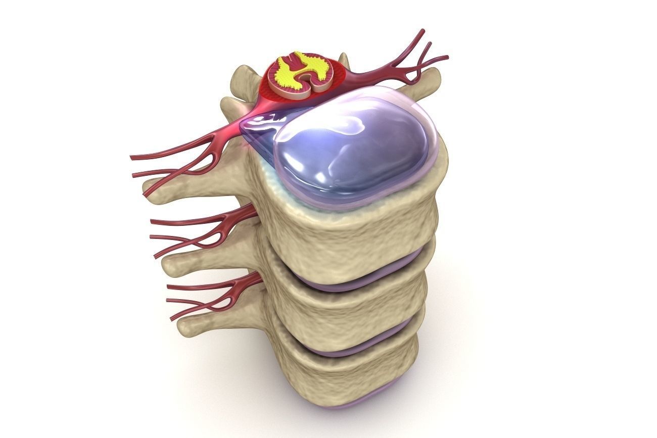 Hernaited  disc in human spine in details  3D model_6